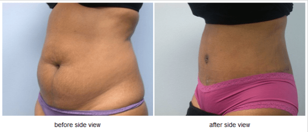 A recent abdominoplasty doctor job in the  area
