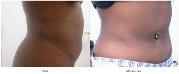 A recent cosmetic surgery liposuction job in the  area