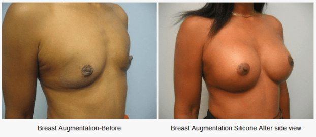 A recent breast augmentation surgeon job in the  area