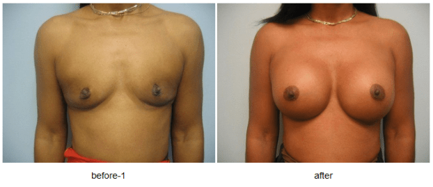 A recent breast augmentation plastic surgeon job in the  area