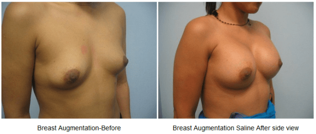 A recent breast augmentation doctor job in the  area
