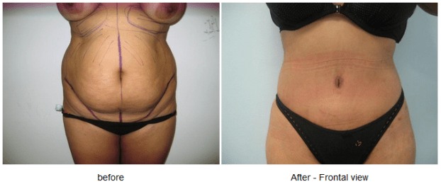 A recent abdominoplasty job in the  area