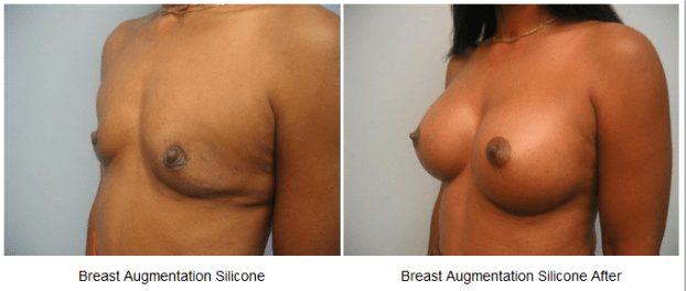 A recent breast enlargement surgeon job in the  area